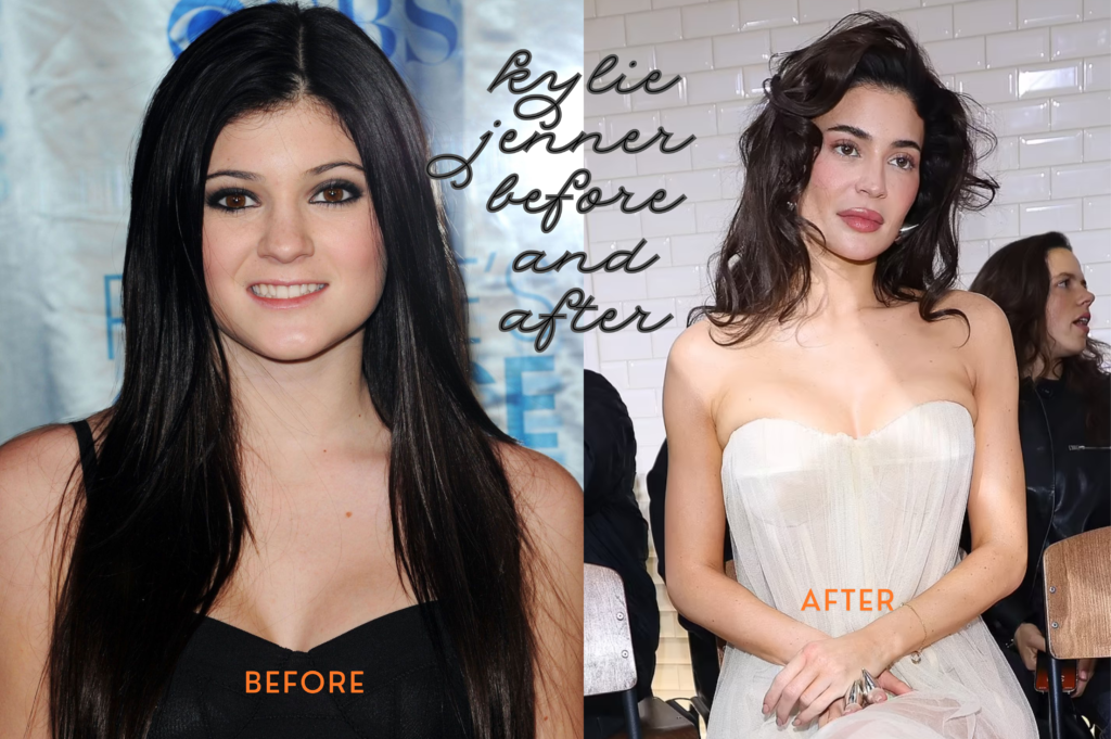 Kylie Jenner Before and After